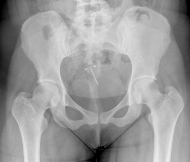 Mirena uterus migration