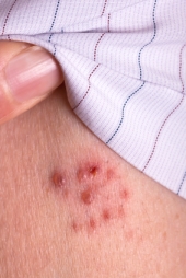 Stevens-Johnson Syndrome Zithromax Z-Pak Class Action Lawsuit Settlement