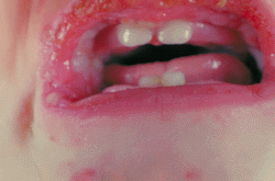Stevens-Johnson Blisters Infant